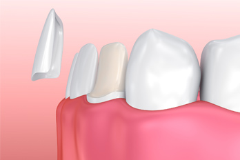 dental veneers
